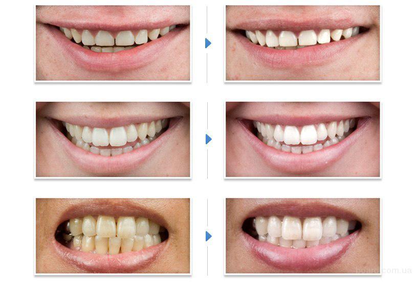 на сколько эффективно отбеливание зубов