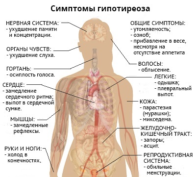 гипотиреоза