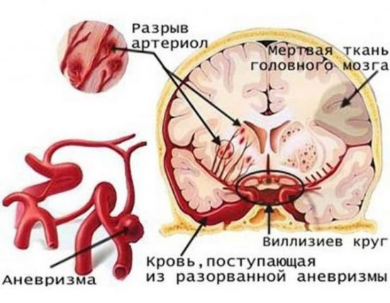 аневризма сосудов головного мозга