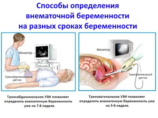 Способы определения внематочной беременности