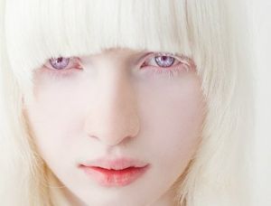 Альбинизм и его плачевные последствия