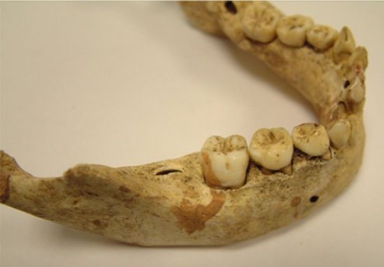 Лечение и профилактика кариеса зубов в средневековьи и в наши дни