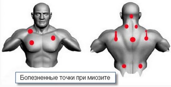 Основные симптомы миозита